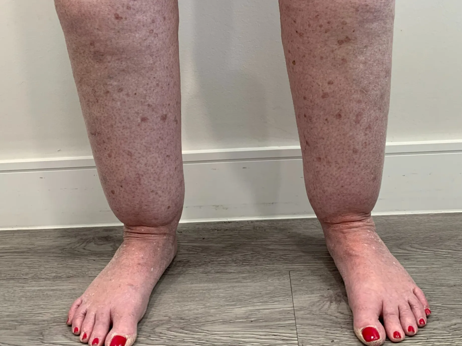 ¿Qué es una Evaluación Fisioterapeuta Lipedema?