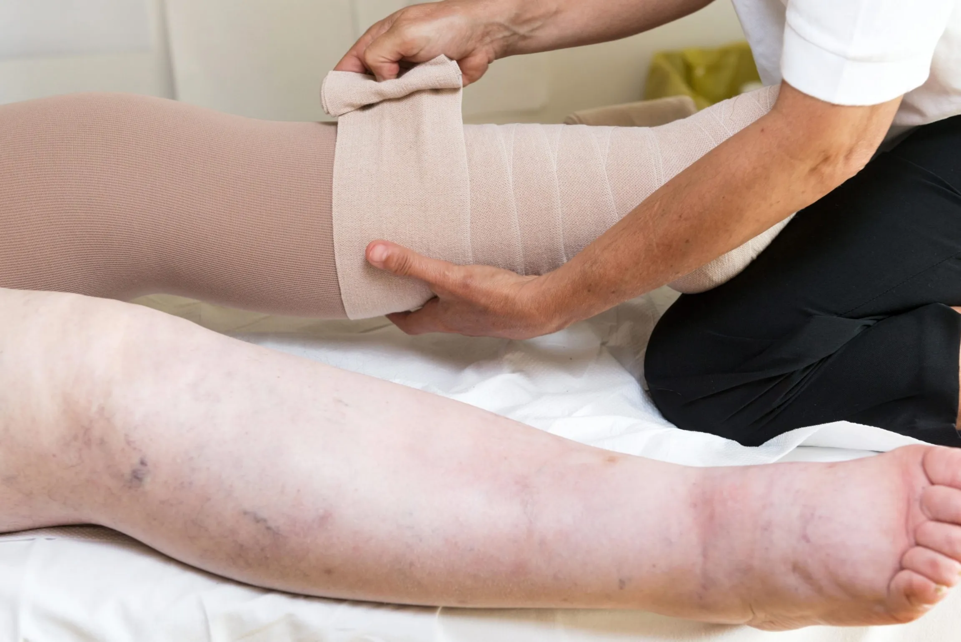 Lipedema y linfedema