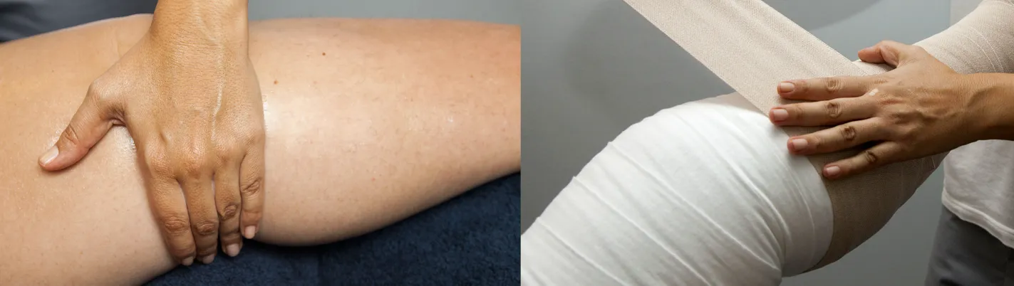 Lipedema y linfedema